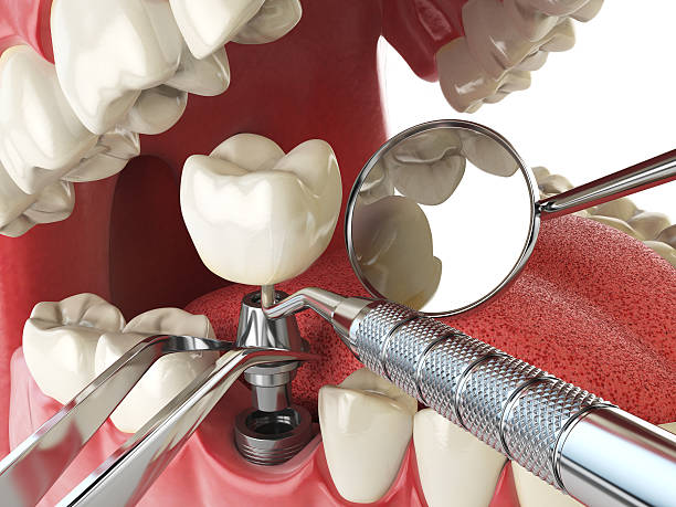 Best Emergency Tooth Extraction in Warren, MI
